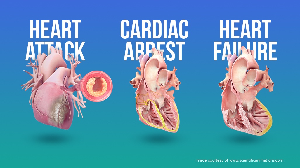 Apa Perbedaan Serangan Jantung, Henti Jantung, dan Gagal Jantung